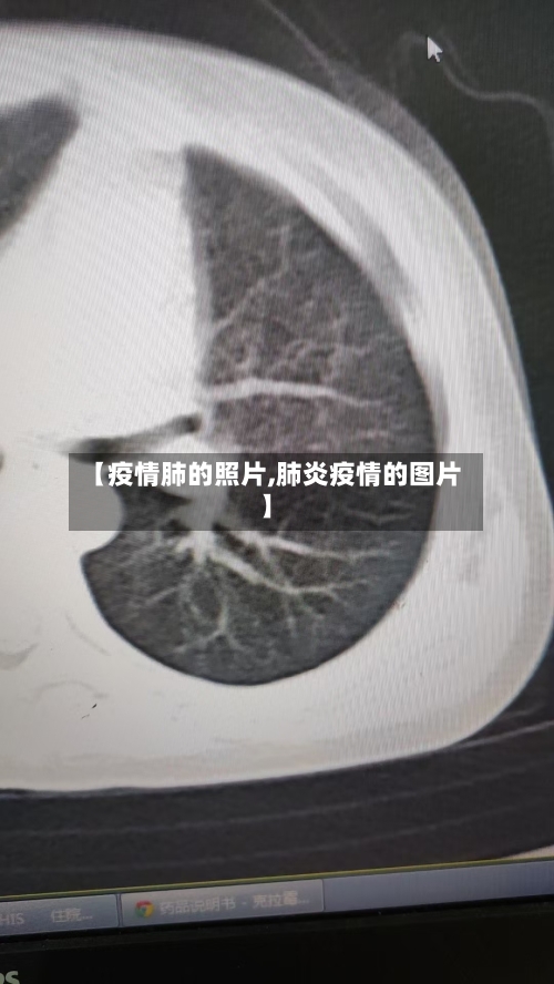 【疫情肺的照片,肺炎疫情的图片】-第2张图片