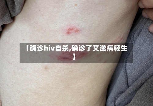 【确诊hiv自杀,确诊了艾滋病轻生】-第3张图片