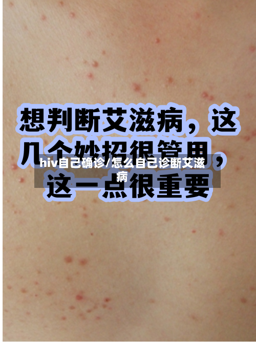 hiv自己确诊/怎么自己诊断艾滋病