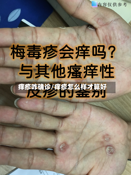 痒疹咋确诊/痒疹怎么样才算好