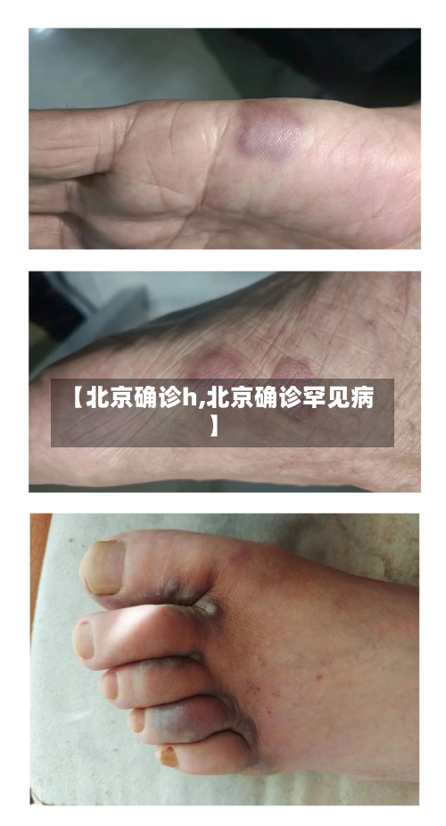 【北京确诊h,北京确诊罕见病】-第2张图片