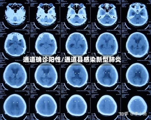 通道确诊阳性/通道县感染新型肺炎